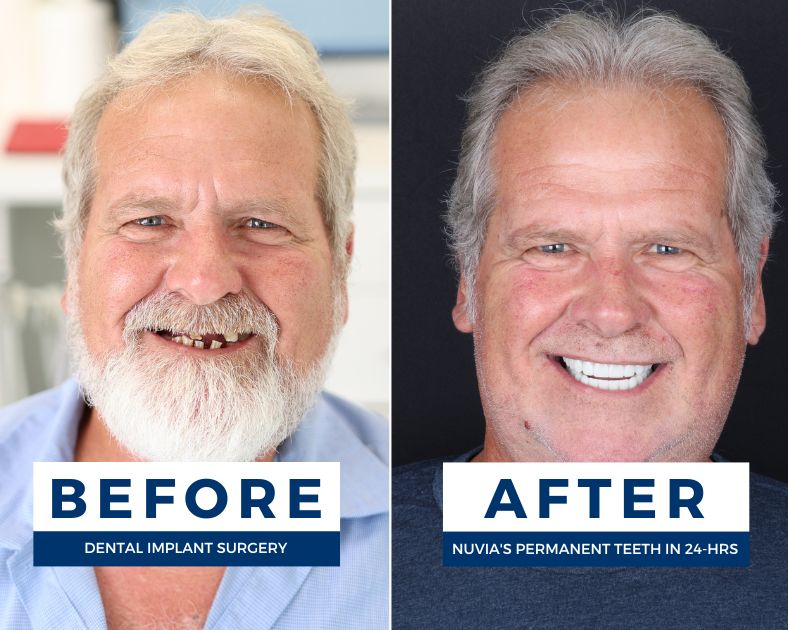 Does Glenn regret dental implants before and after
