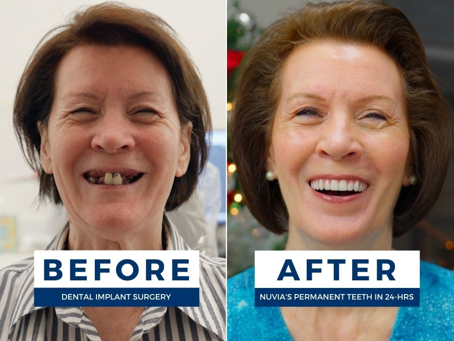 Woman smiling before and after dental implants