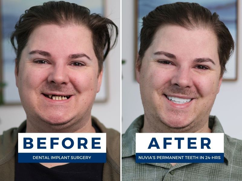 Man smiling before and after All-on-4® Dental Implant Problems