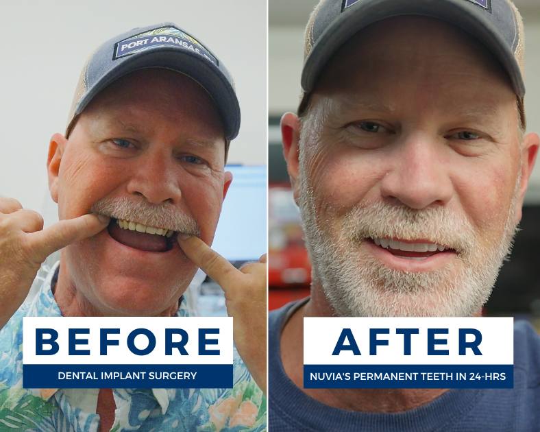 Man smiling before and after getting natural feeling dental implants