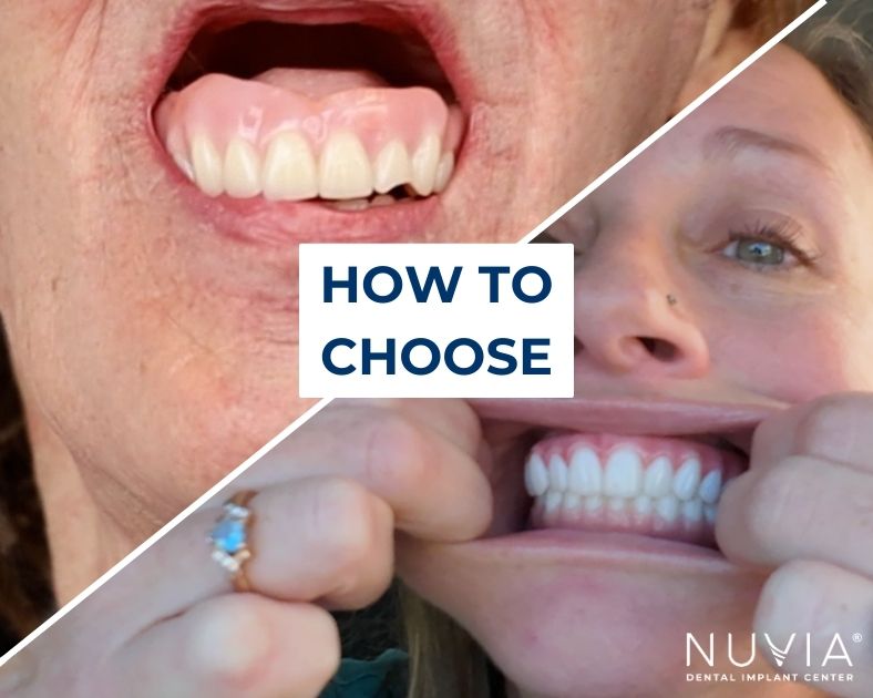 Affordable dentures vs affordable dental implants