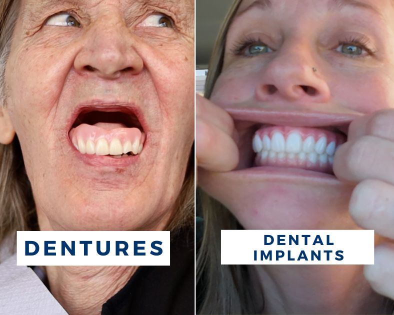 Affordable Dentures vs affordable dental implants