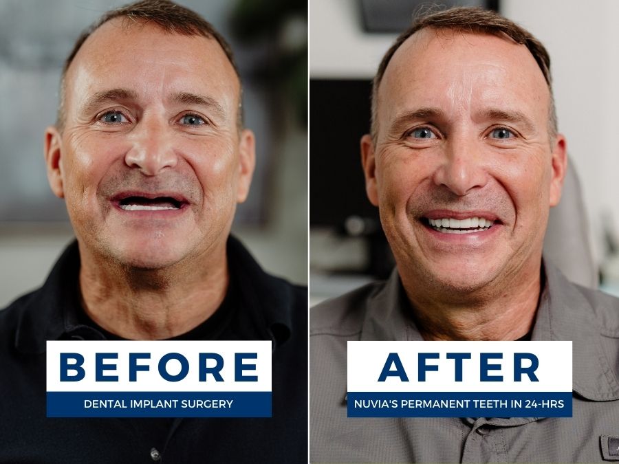 Before and After what zygomatic dental implants look like