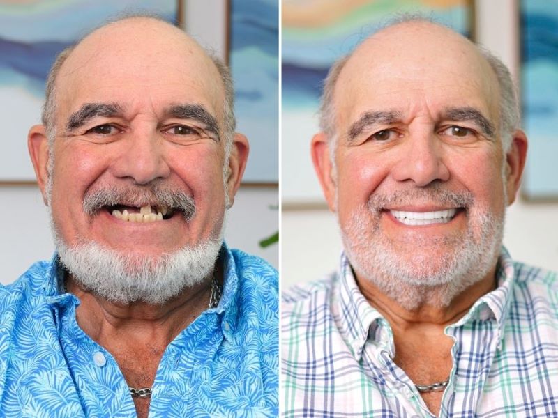 Man smiling before and after immediate load dental implants