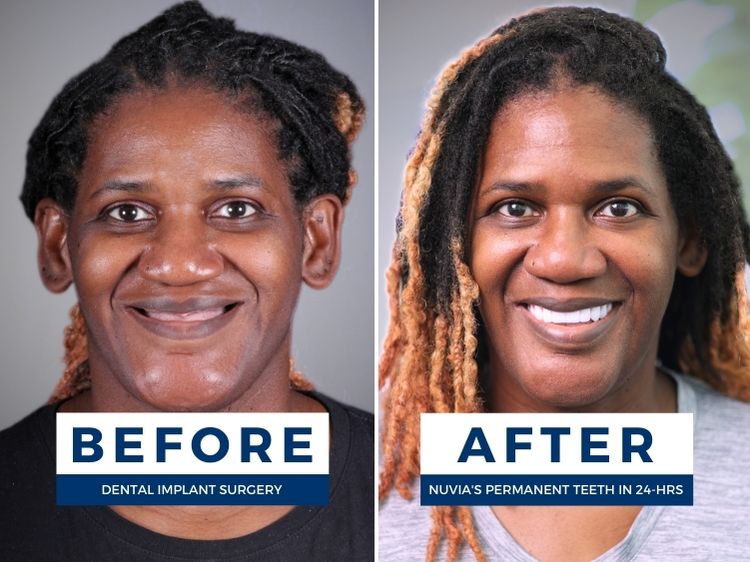 Patient smiling before and after whole mouth implants