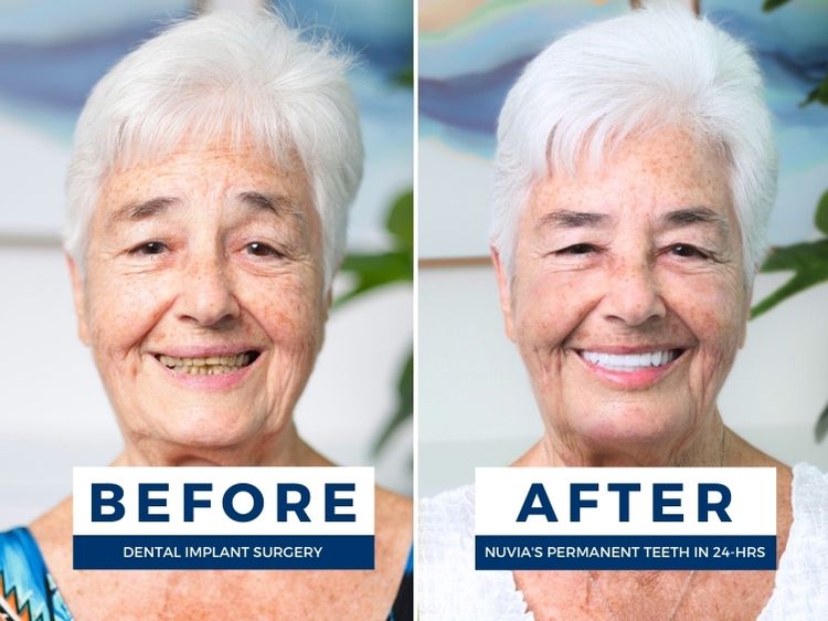 Woman smiling before and after whole mouth implants