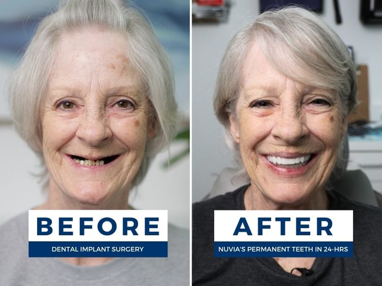 Woman smiling before and after dental implants for seniors