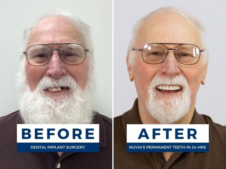 Man smiling before and after getting dental implants for seniors