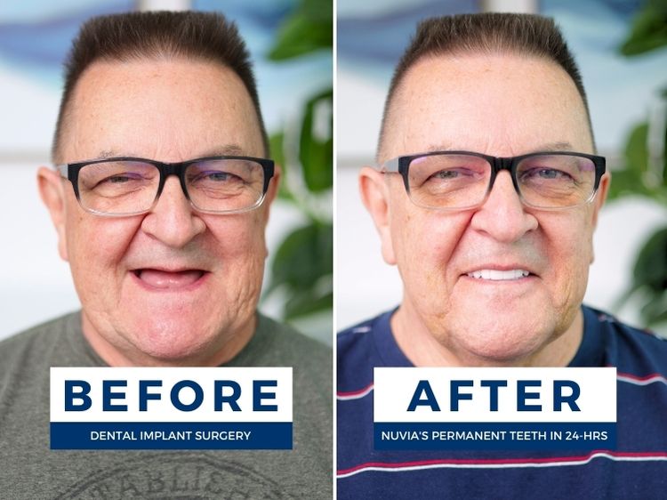 Man smiling before and after getting dental implants in las vegas, nv