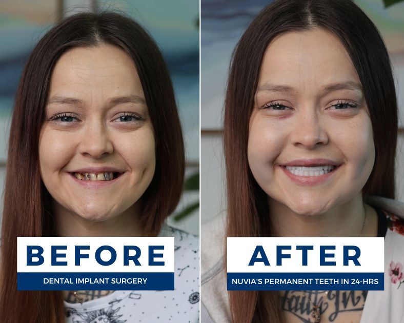 Woman smiling before and after getting dental implants to replace dentures for back teeth