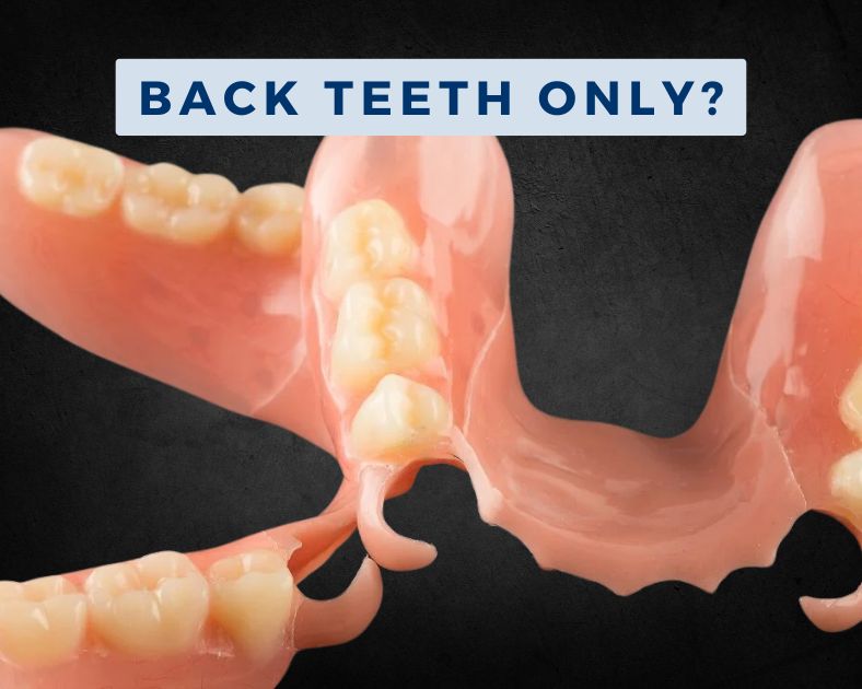 Partial Dentures for Back Teeth