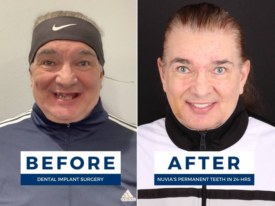 Man smiling before and after having dental implants gone wrong story