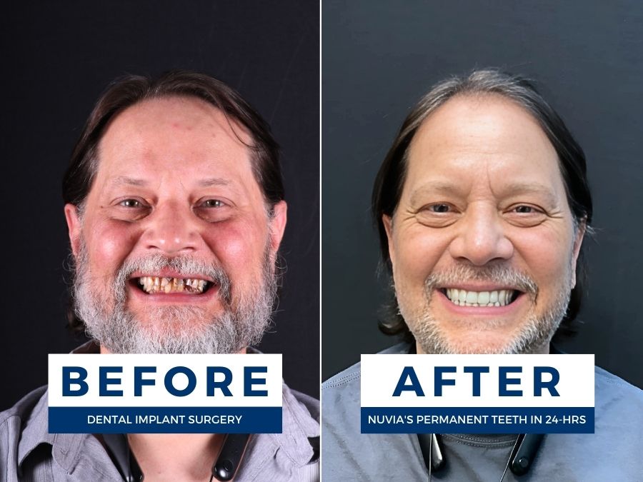 Man smiling before and after dental implant surgery