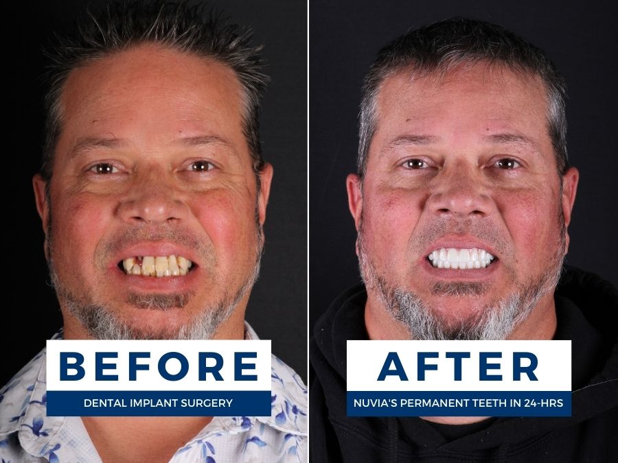 Man smiling before and after getting dental implant surgery