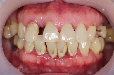 Closeup image of natural teeth with gum disease