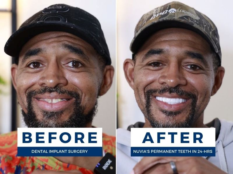 Man smiling before and after dental implant surgery recovery