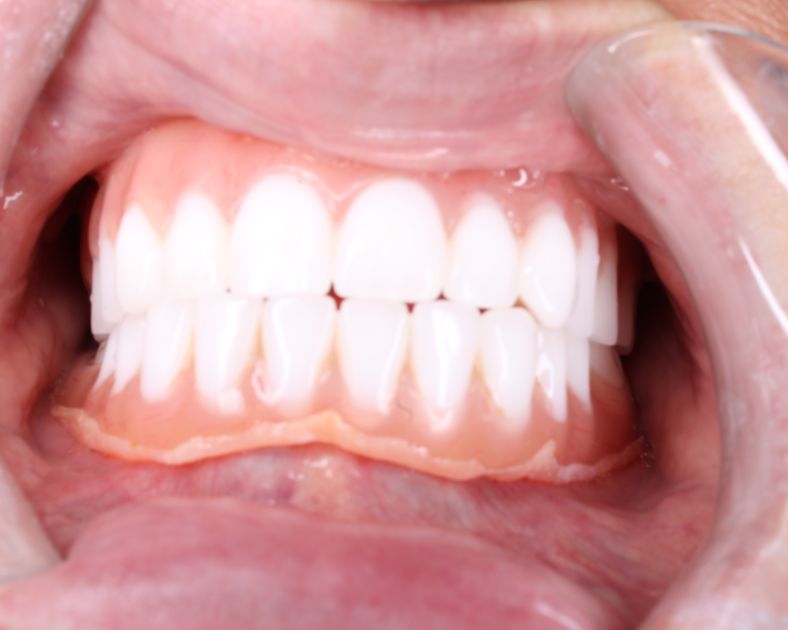 First time denture wearer problems being shown in a close up of dentures