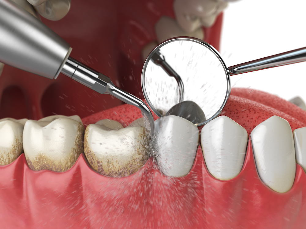 Dental cleaning to remove periodontal disease