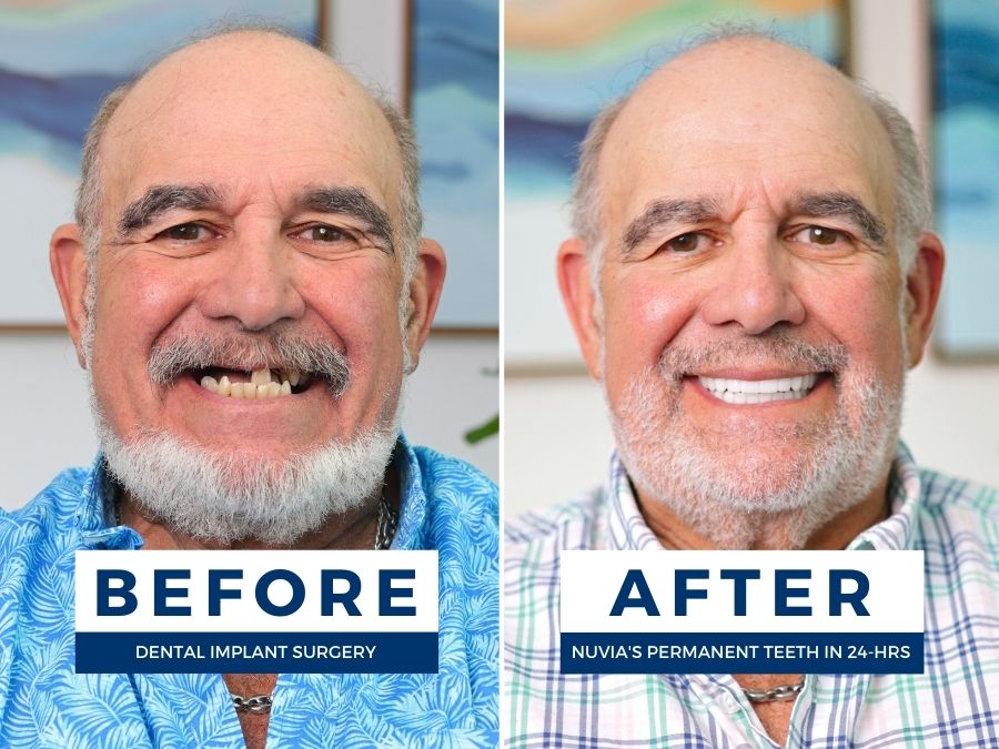 Man with periodontal disease before getting dental implants