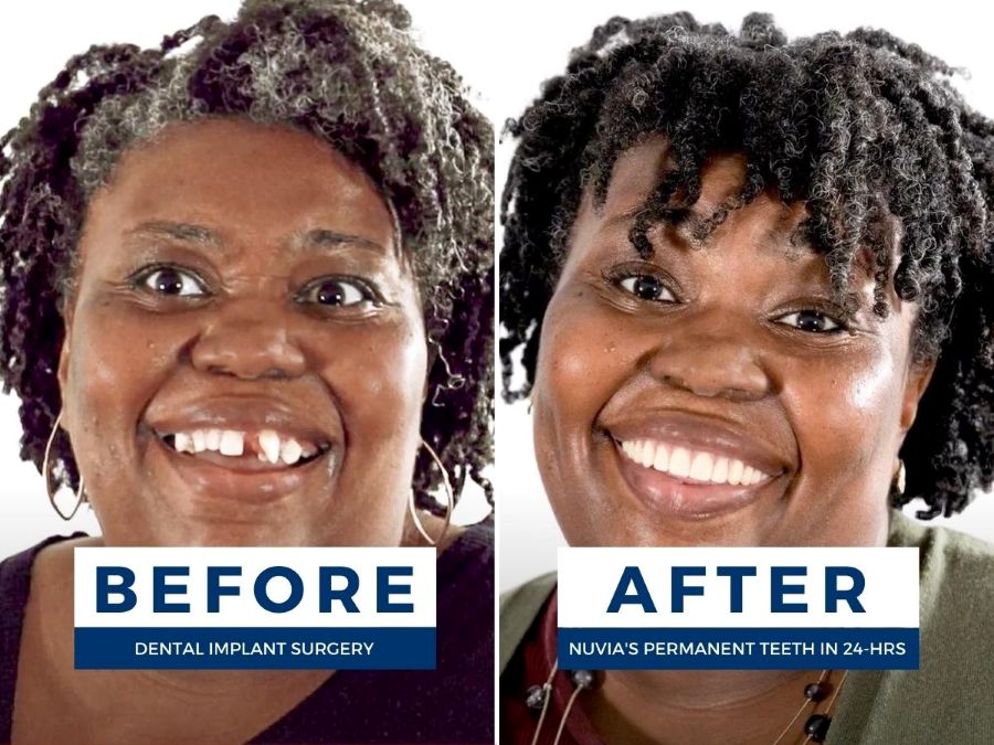 Sharala before and after getting upper implants