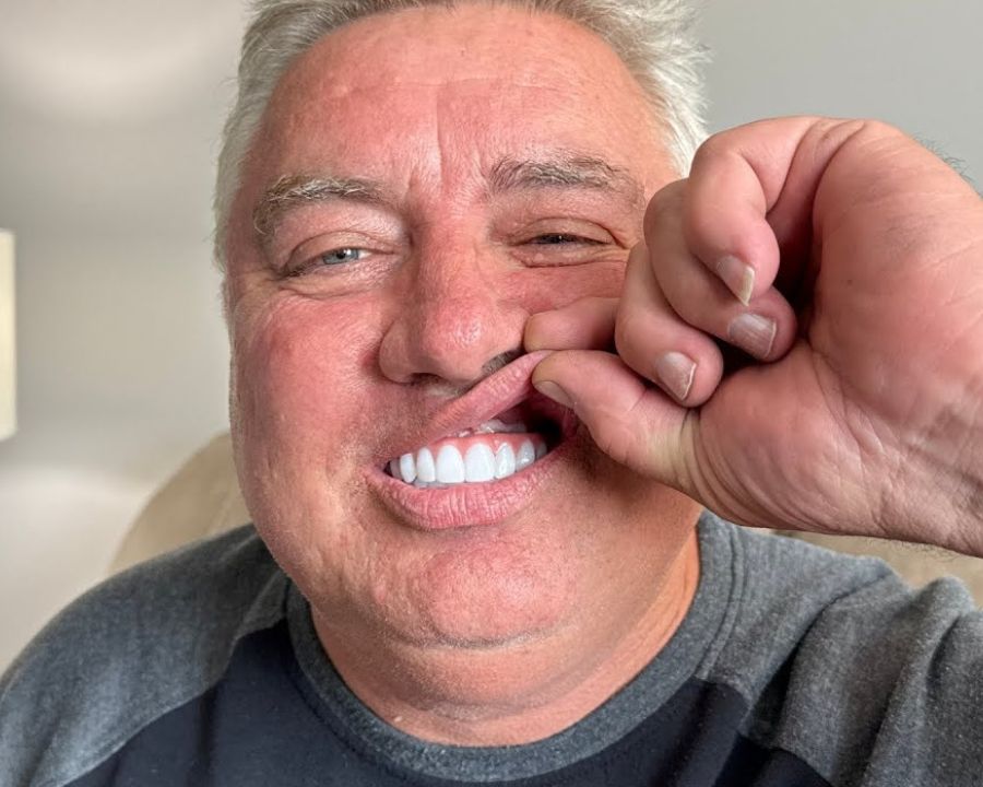Man pulling up his top lip to show his teeth