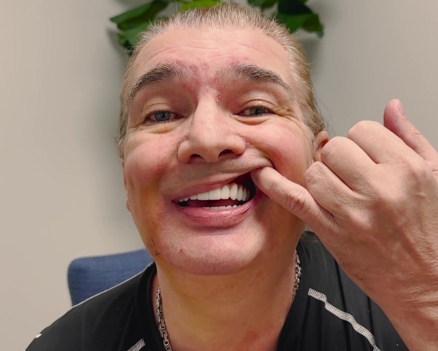 Man pulling up his top lip to show his teeth