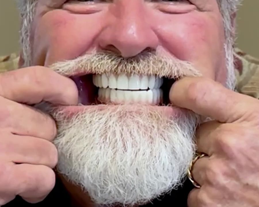 Man pulling back lips to show what do full mouth dental implants look like