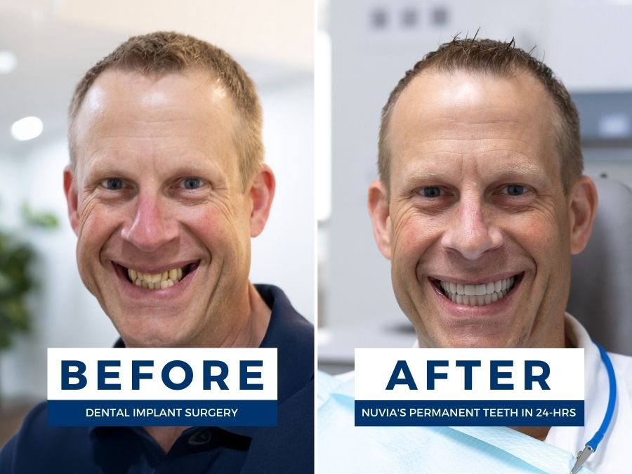 Man smiling before and after finding out how long do dental implants take