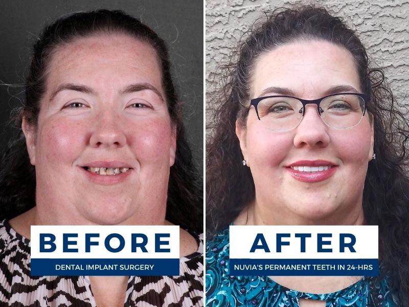 Tricia smiling before and after getting dental implants