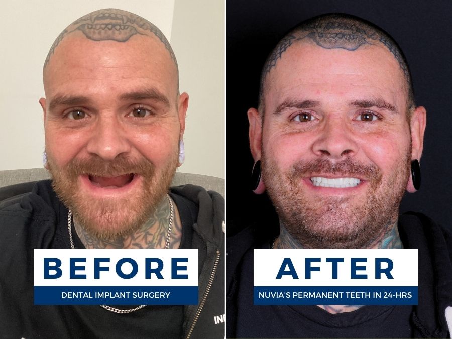 Before and after getting new dental implants