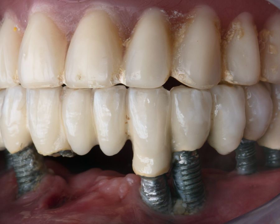 Failed dental implants require new dental implants