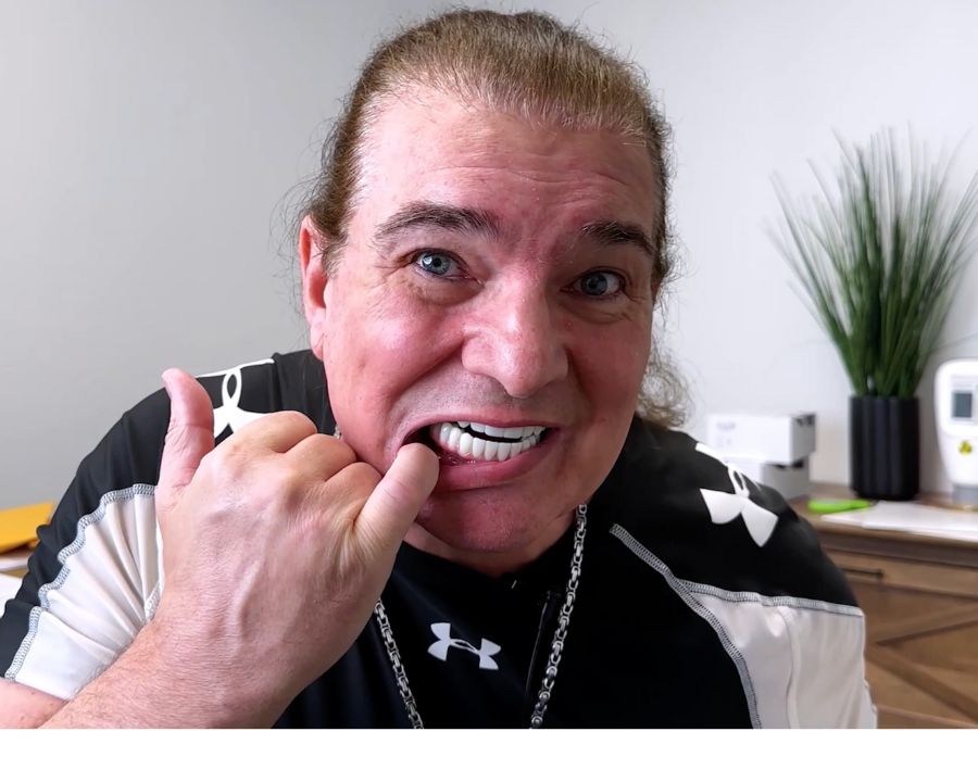 man pulling down lip to show his lower dental implants