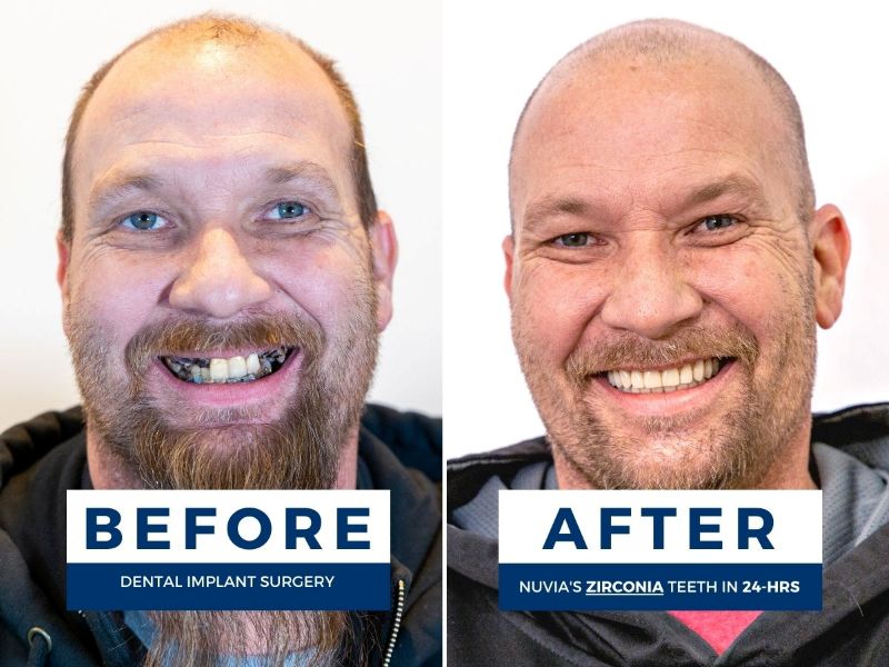Man smiling before and after his life with dental implants