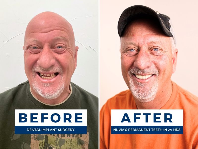 Are dental implants a good idea, man smiles before and after