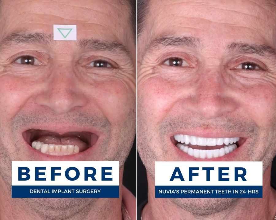 Christopher smiling before and after getting full mouth dental implants
