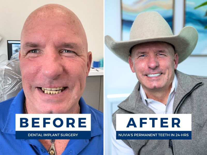 Ricky smiling before and after getting dental implants