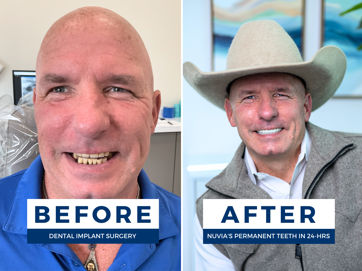 How much is a full set of dental implants before and after