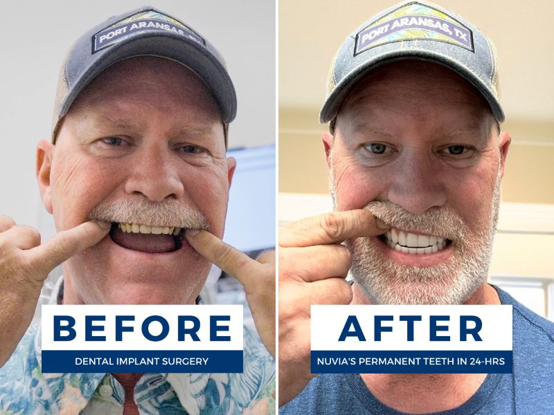 Troy showing his dental implants before and after