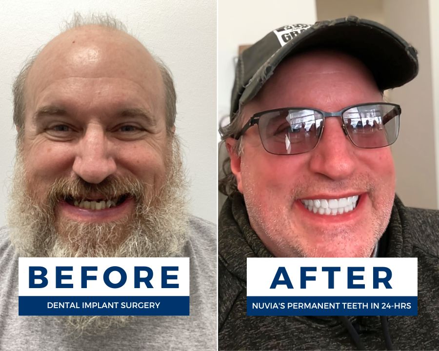 Man smiling before when he experienced pros and cons of dentures vs smiling after with dental implants