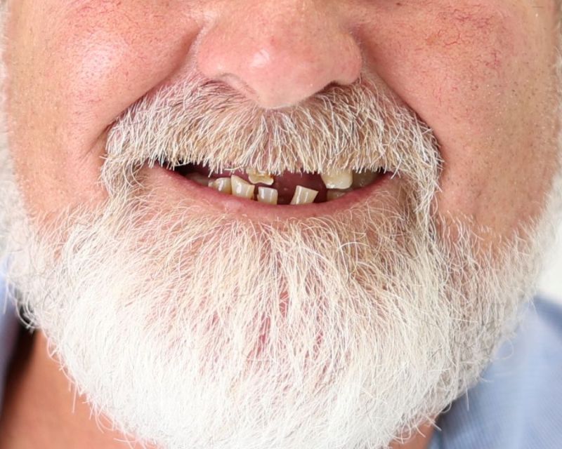 Man smiling with bad teeth