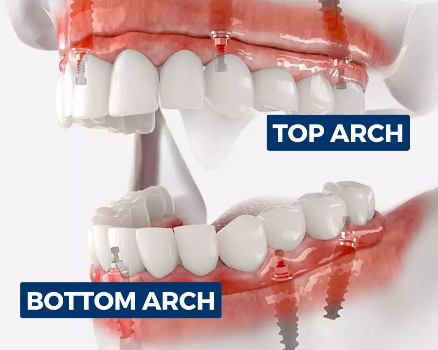 Graphic showing top and bottom arch in dental implants