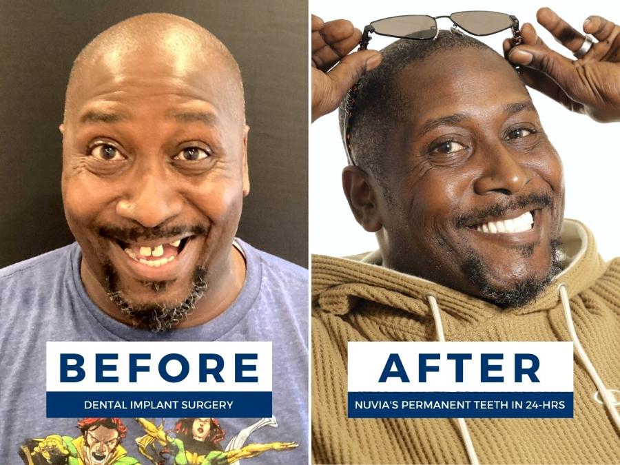 Bishop smiling before and after getting dental implants