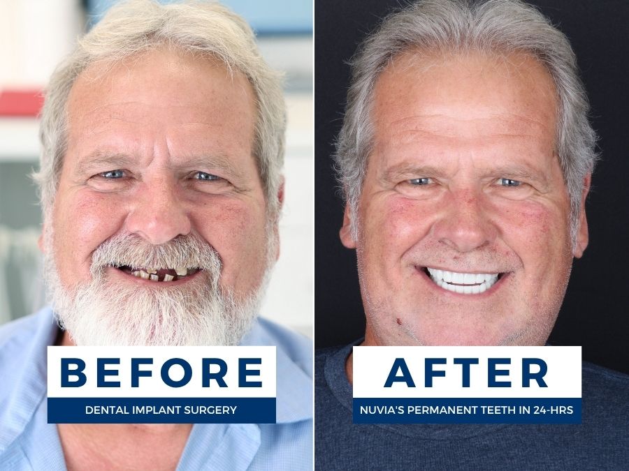 Man smiling before and after getting dental implants