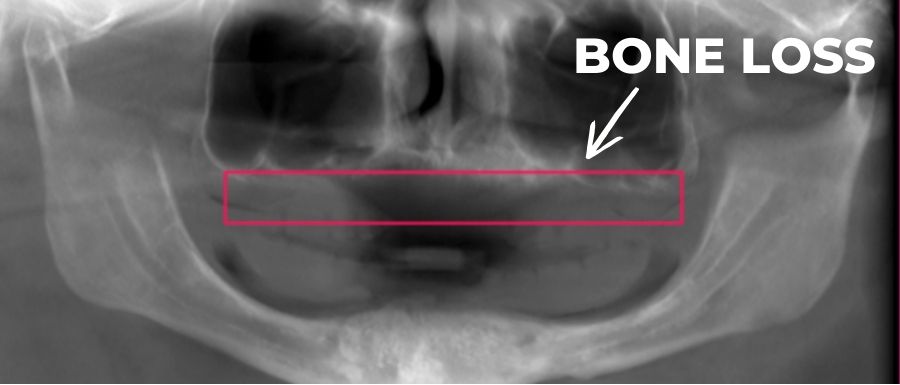 Scan showing bone loss