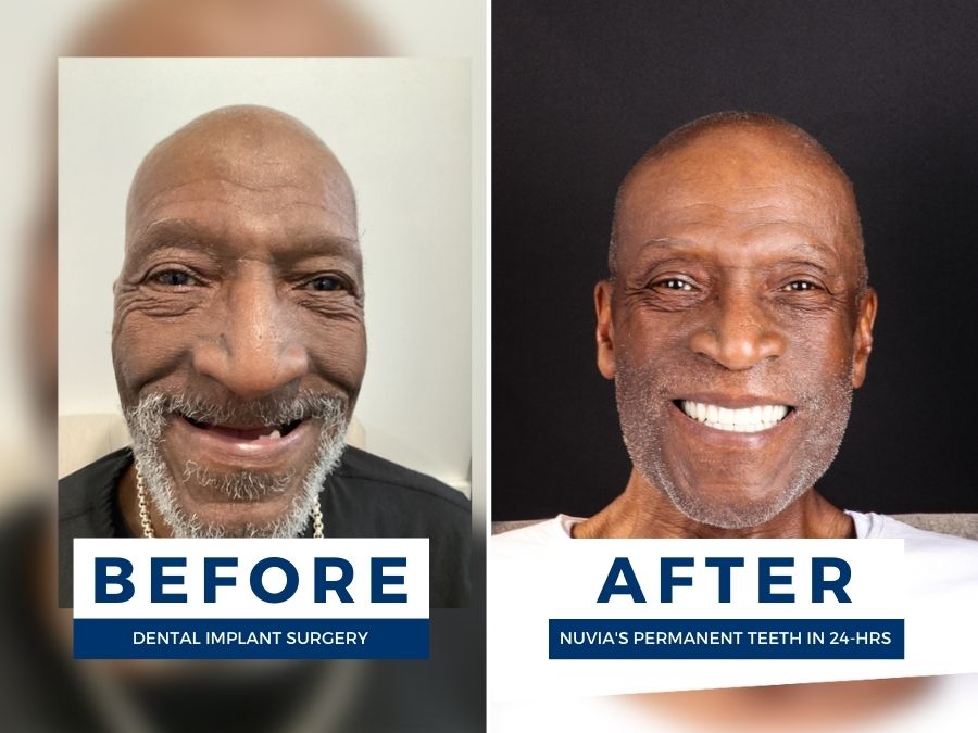 Man smiling before and after getting full mouth dental implants