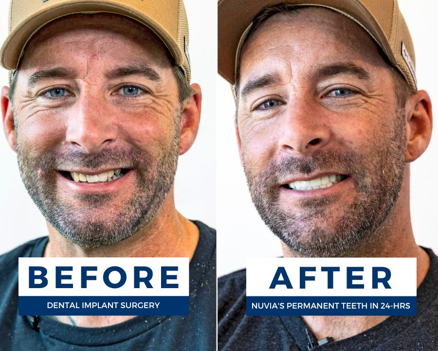 Tony smiling before and after getting dental implants