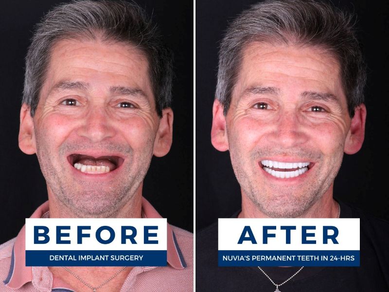 Christopher smiling before and after getting new teeth in 24 hours