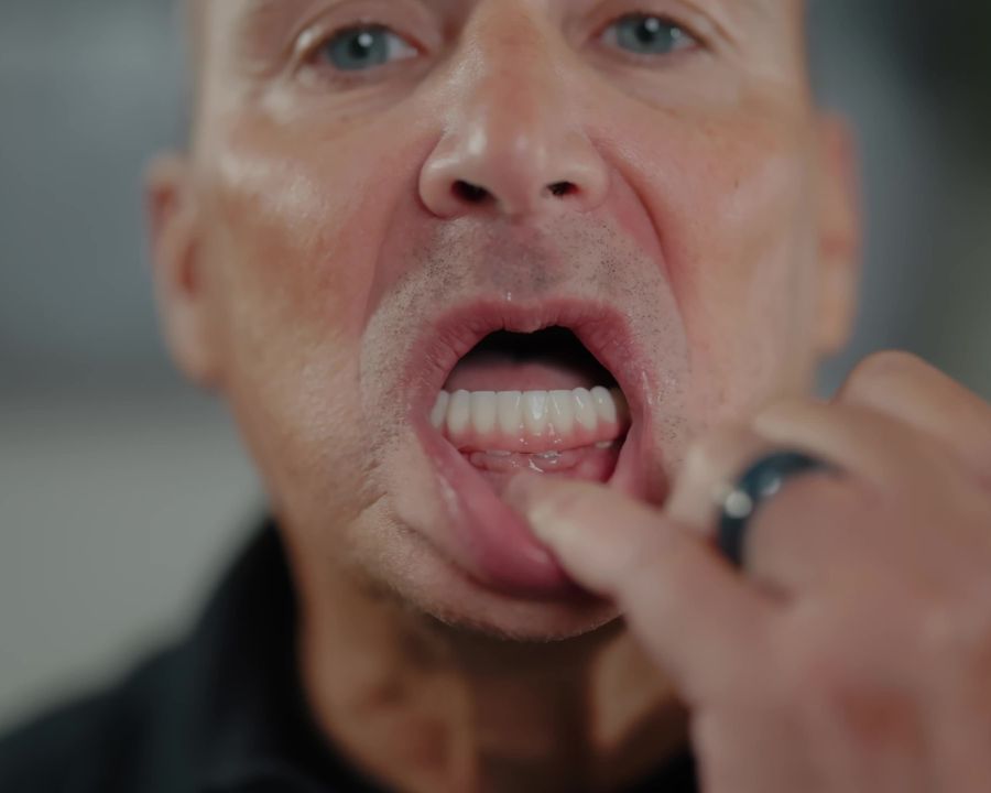 Man pulling down lower lip to show bottom arch of teeth