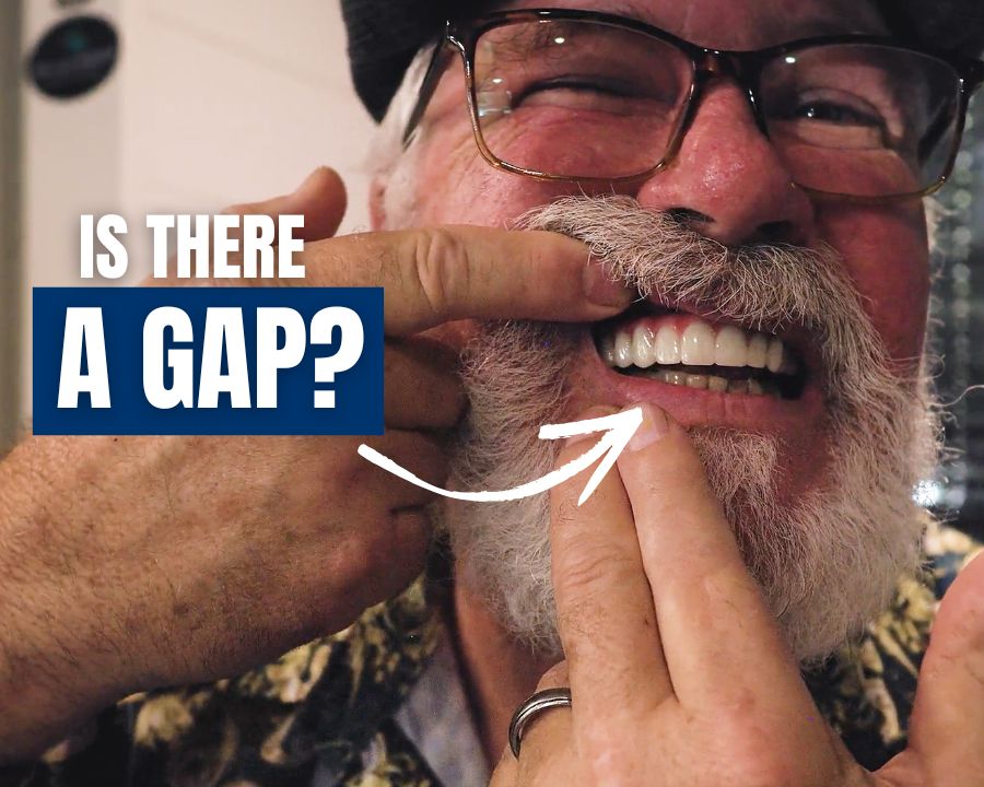 Man pulling back lip to show his zirconia teeth with text that says "is there a gap"