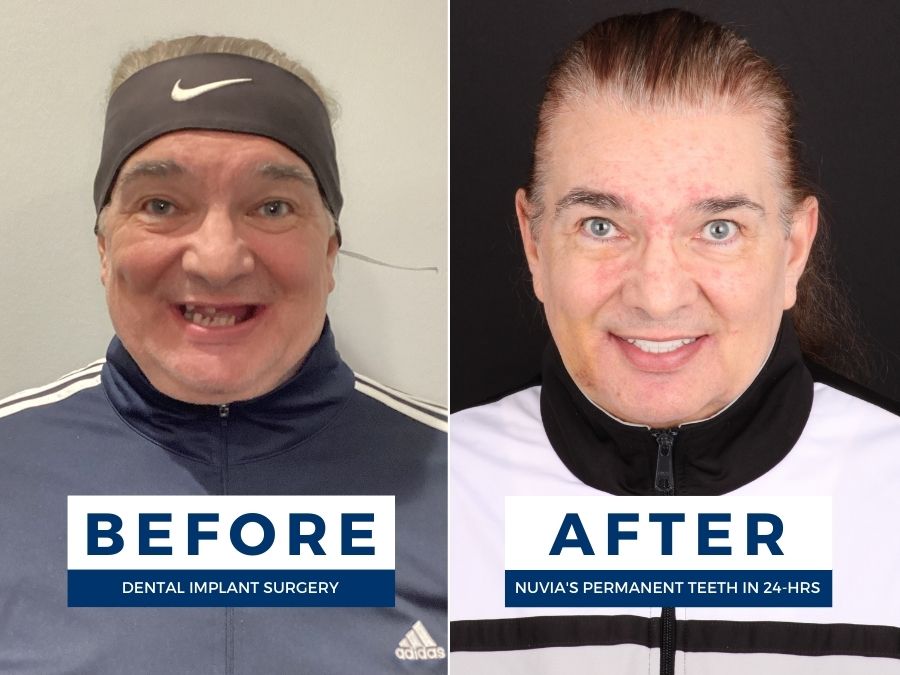 Scott smiling before and after getting dental implants